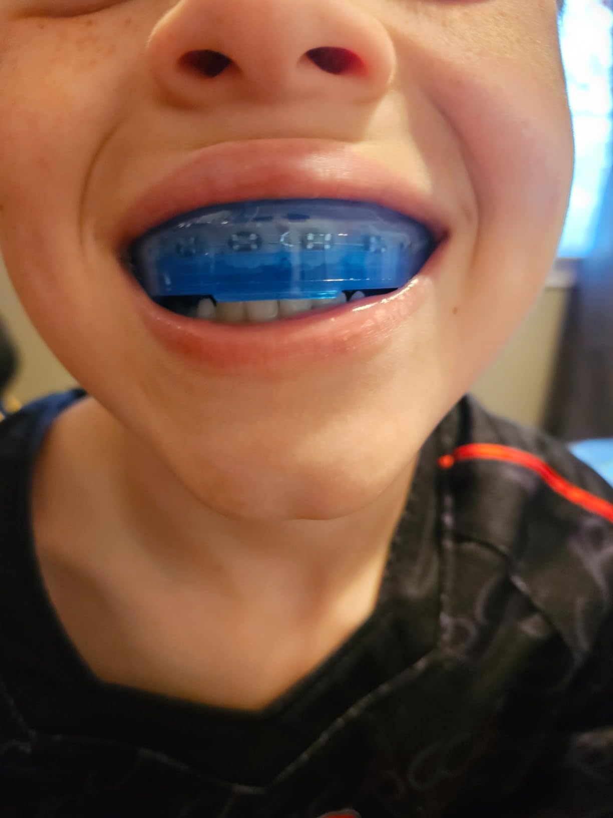 Shock Doctor Orthodontic Mouth Guard Braces for Sports, Hockey, Lacrosse, Football, Baseball, Upper Teeth Protection, Adult & Youth Sizes customer photo 1