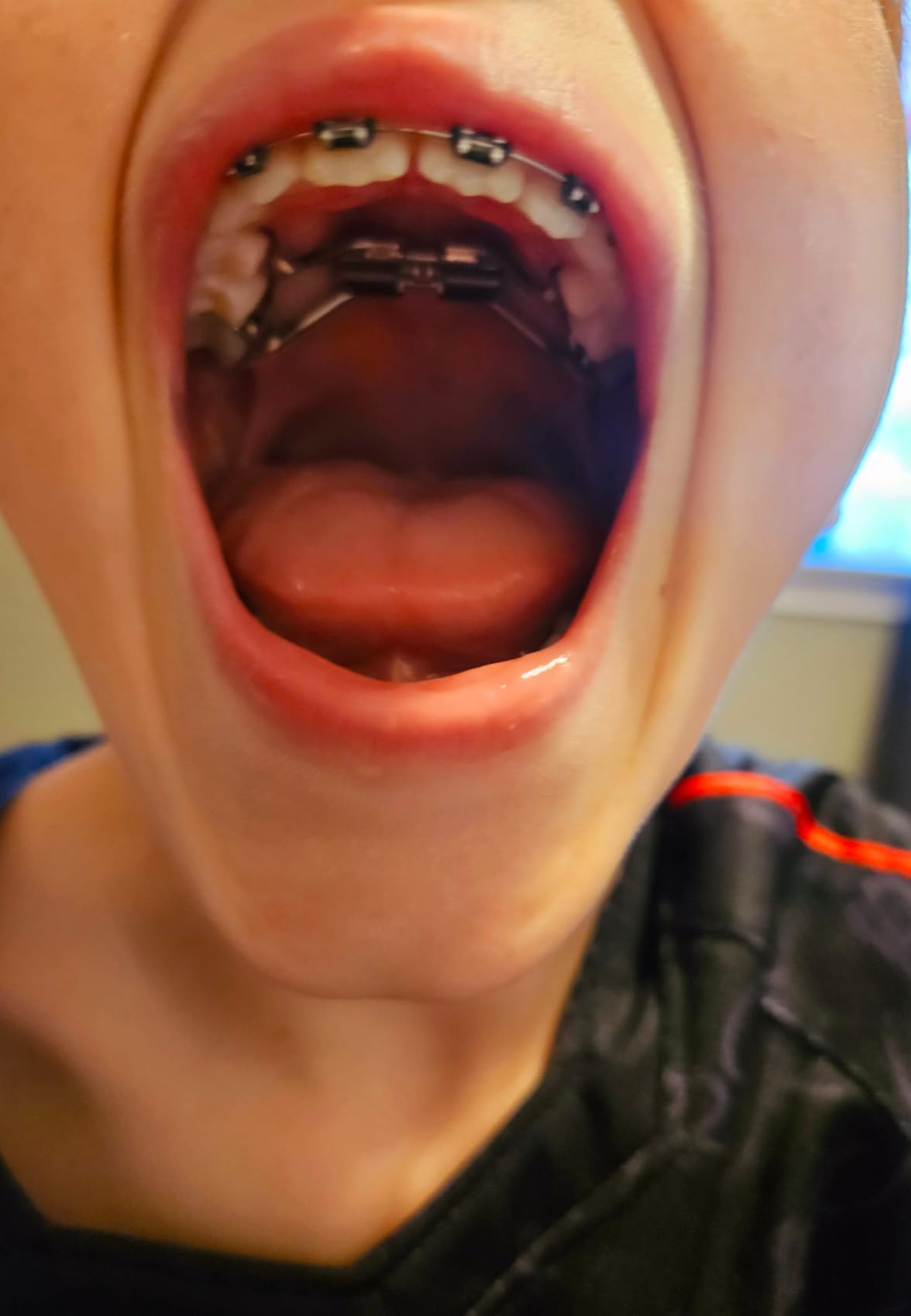 Shock Doctor Orthodontic Mouth Guard Braces for Sports, Hockey, Lacrosse, Football, Baseball, Upper Teeth Protection, Adult & Youth Sizes customer photo 2