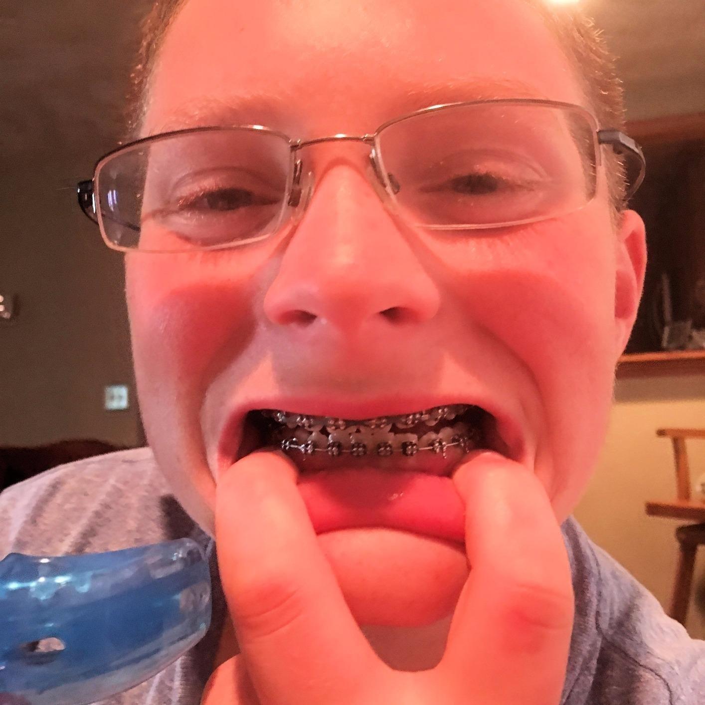 Shock Doctor Double Braces Strapless Mouth Guard, Blue, Adult customer photo 2