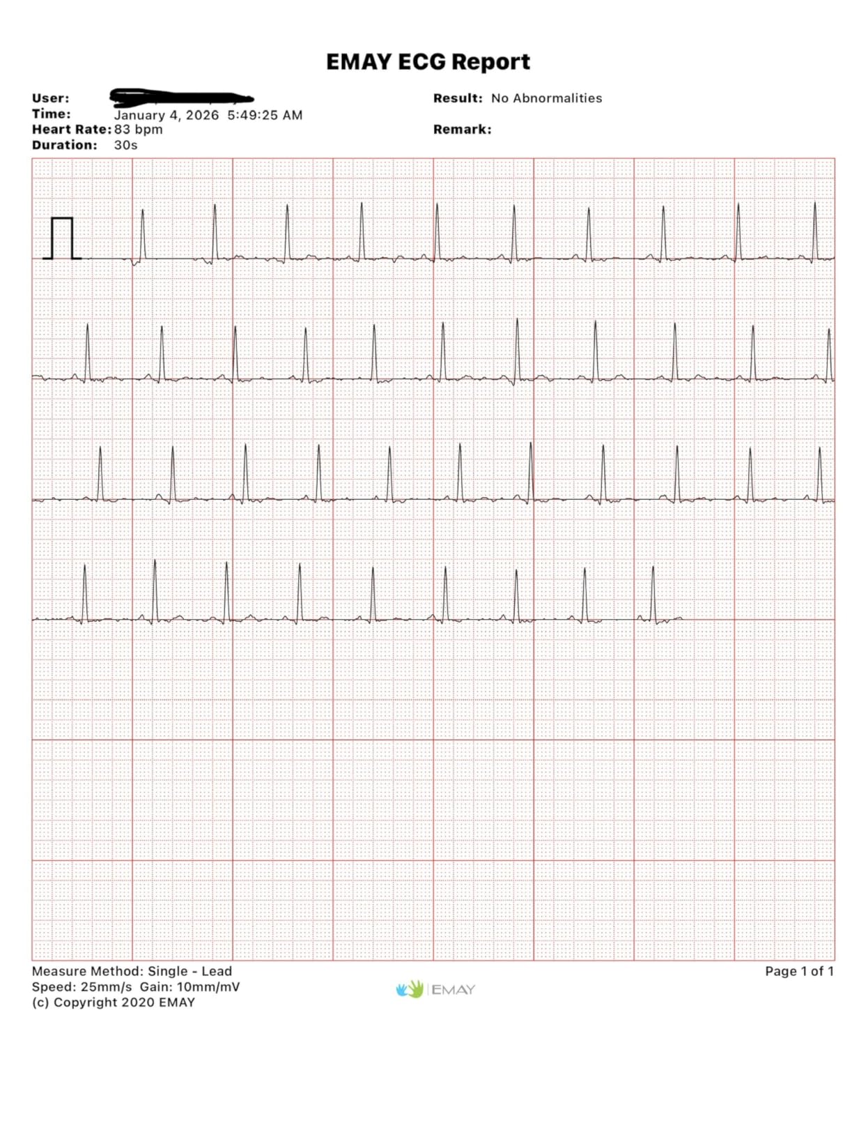 EMAY Portable ECG Monitor | Record ECG and Heart Rate | Compatible with Smartphone and PC customer photo 1