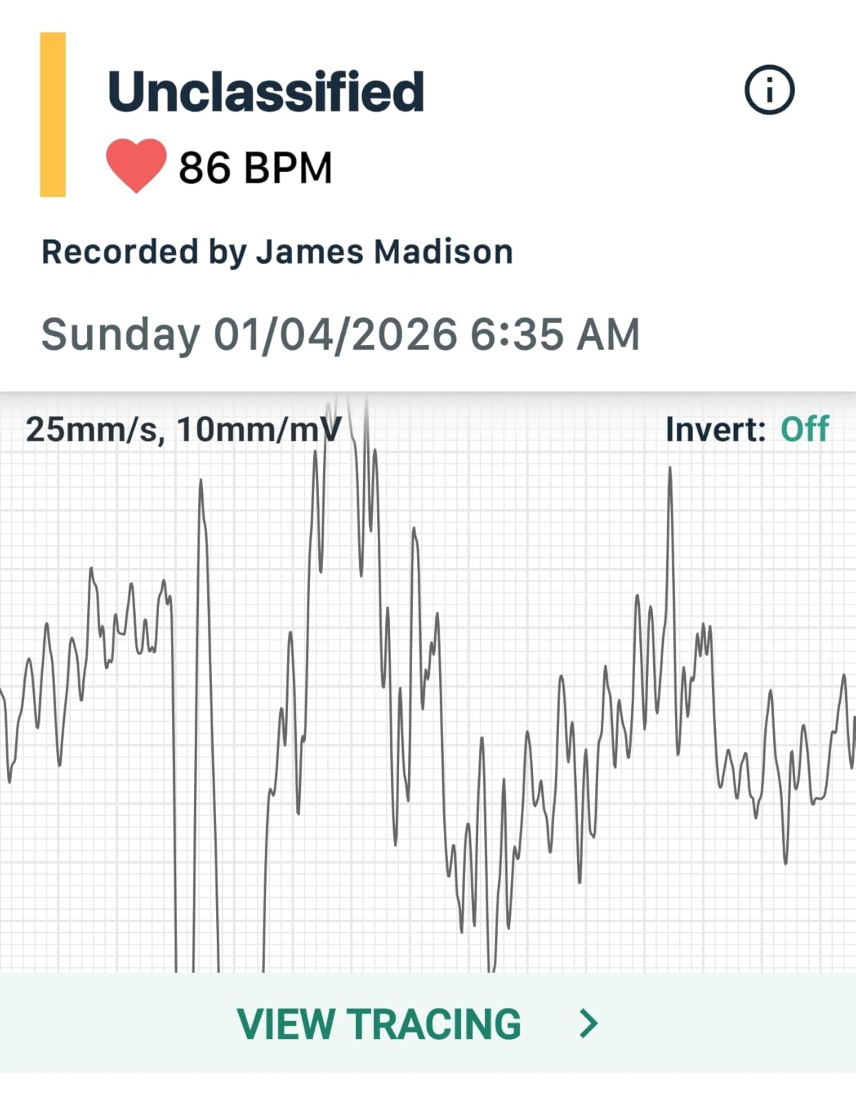 KardiaMobile 1-Lead EKG Monitor, Medical-Grade FDA-Cleared Personal Heart Monitor, Detects Normal, AFib & Arrhythmias, 30 Second Results, Works with Smartphones, Pocket Size, No Subscription Required customer photo 2