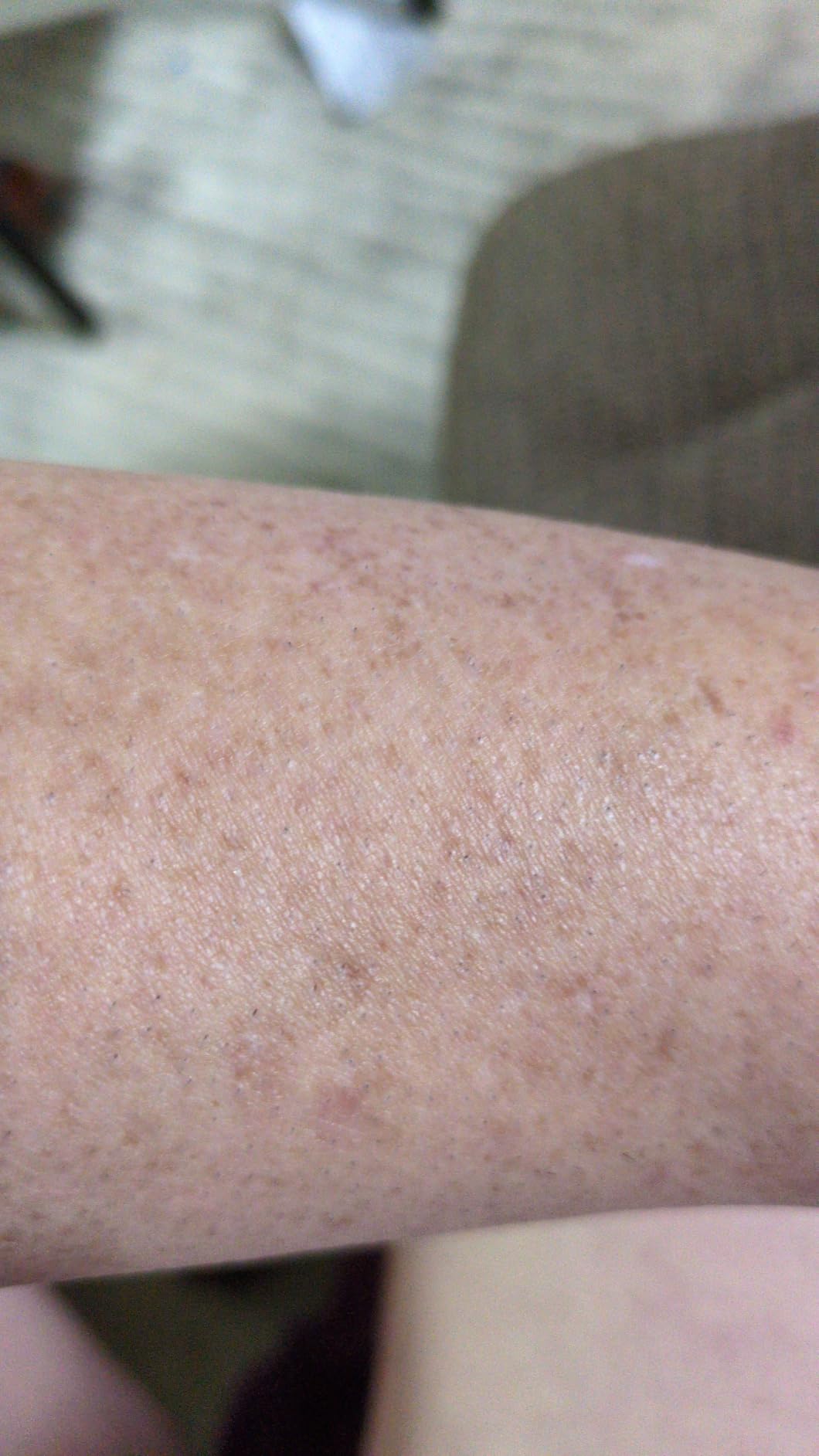 Nood Flasher Pro IPL Laser Hair Removal Device customer photo 1